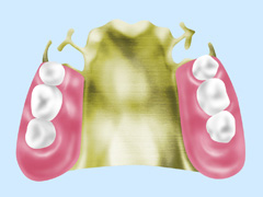 金属床義歯（ゴールド・チタン・コバルトクロム）