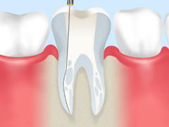重度の虫歯でもできるだけ抜歯を避ける～根管治療～