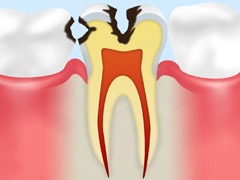 C2：象牙質の虫歯