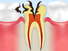C3：神経にまでおよんだ虫歯