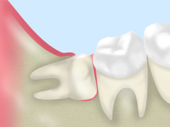 親知らずの抜歯・治療