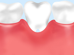歯周病とは