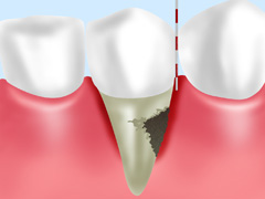 歯周ポケットそうは術