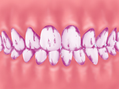 歯垢（プラーク）の染め出し（小児）